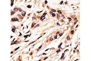 IHC analysis of FFPE human breast carcinoma tissue stained with the phospho-Rb antibody. (Retinoblastoma Protein (Rb) anticorps  (pSer608))