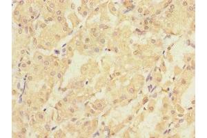 Immunohistochemistry of paraffin-embedded human gastric cancer using ABIN7163386 at dilution of 1:100 (PMM2 anticorps  (AA 1-246))