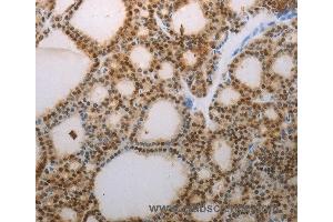 Immunohistochemistry of Human thyroid cancer using S100A1 Polyclonal Antibody at dilution of 1:70 (S100A1 anticorps)