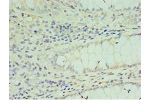 Immunohistochemistry of paraffin-embedded human colon cancer using ABIN7172637 at dilution of 1:100 (SOX6 anticorps  (AA 1-74))