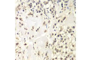Immunohistochemistry of paraffin-embedded human kidney cancer using USP7 antibody at dilution of 1:200 (400x lens). (USP7 anticorps)