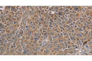 Immunohistochemistry of paraffin-embedded Human ovarian cancer tissue using NDUFS7 Polyclonal Antibody at dilution 1:40