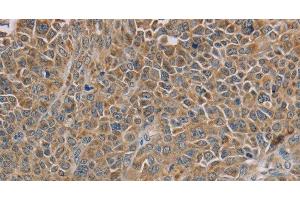Immunohistochemistry of paraffin-embedded Human ovarian cancer tissue using NDUFS7 Polyclonal Antibody at dilution 1:40 (NDUFS7 anticorps)
