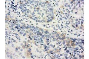 Immunohistochemical staining of paraffin-embedded Carcinoma of Human bladder tissue using anti-LIN7B mouse monoclonal antibody. (LIN7B anticorps)