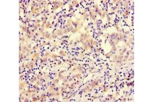 Immunohistochemistry of paraffin-embedded human lung cancer using ABIN7171083 at dilution of 1:100