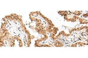 Immunohistochemistry of paraffin-embedded Human thyroid cancer tissue using FAM84B Polyclonal Antibody at dilution of 1:70(x200) (FAM84B anticorps)