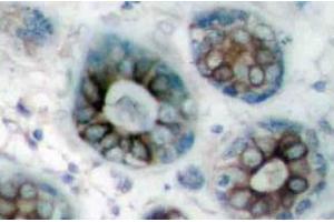 Immunohistochemistry (IHC) analyzes of GAP43 antibody in paraffin-embedded human breast carcinoma tissue. (GAP43 anticorps)