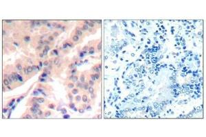 Immunohistochemical analysis of paraffin-embedded human lung carcinomatissue using eIF4B(Phospho-Ser422) Antibody(left) or the same antibody preincubated with blocking peptide(right).
