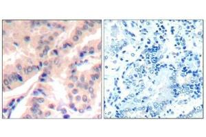 Immunohistochemical analysis of paraffin-embedded human lung carcinomatissue using eIF4B(Phospho-Ser422) Antibody(left) or the same antibody preincubated with blocking peptide(right). (EIF4B anticorps  (pSer422))