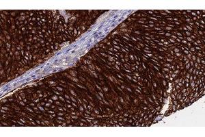 ABIN6276368 at 1/100 staining Human urothelial cancer tissue by IHC-P. (CD40 Ligand anticorps  (Internal Region))
