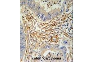 PRB2 Antibody (C-term) (ABIN6244055 and ABIN6578967) immunohistochemistry analysis in formalin fixed and paraffin embedded human colon carcinoma followed by peroxidase conjugation of the secondary antibody and DAB staining. (PRB2 anticorps  (C-Term))
