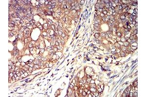 Immunohistochemical analysis of paraffin-embedded cervical cancer tissues using ACTR3 mouse mAb with DAB staining. (ACTR3 anticorps  (AA 287-418))