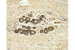 IHC analysis of FFPE human breast carcinoma with HER3 antibody