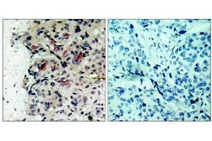 Immunohistochemical analysis of paraffin-embedded human breast carcinoma tissue using JAK1 (Ab-1022) antibody (E021119). (JAK1 anticorps)