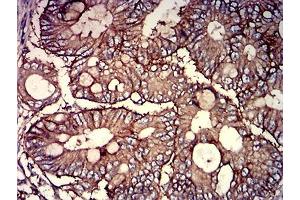 Immunohistochemical analysis of paraffin-embedded rectum cancer tissues using CD46 mouse mAb with DAB staining. (CD46 anticorps  (AA 35-179))