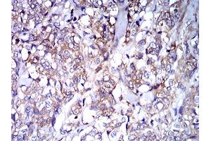 Immunohistochemical analysis of paraffin-embedded breast cancer tissues using IghA1 mouse mAb with DAB staining. (IGHA1 anticorps  (AA 207-353))