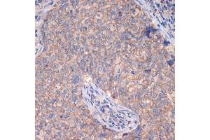 Immunohistochemistry of paraffin-embedded human breast cancer using CTNN Rabbit mAb (ABIN7266135) at dilution of 1:100 (40x lens). (CTNNA3 anticorps)