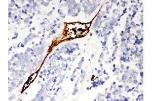 Anti- Mesothelin Picoband antibody,IHC(P) IHC(P): Human Lung Cancer Tissue