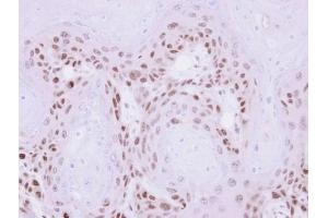 IHC-P Image Immunohistochemical analysis of paraffin-embedded Ca922 xenograft , using MAGEA11, antibody at 1:500 dilution. (MAGEA11 anticorps  (N-Term))