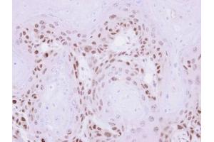 IHC-P Image Immunohistochemical analysis of paraffin-embedded Ca922 xenograft , using MAGEA11, antibody at 1:500 dilution.