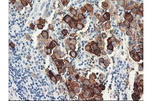 Immunohistochemical staining of paraffin-embedded Carcinoma of Human lung tissue using anti-DPP10 mouse monoclonal antibody. (DPP10 anticorps)