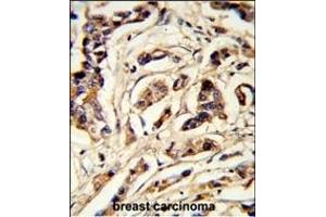 Formalin-fixed and paraffin-embedded human breast carcinoma reacted with TSHB Antibody (Center), which was peroxidase-conjugated to the secondary antibody, followed by DAB staining. (TSHB anticorps  (AA 58-86))