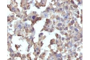 Formalin-fixed, paraffin-embedded human Histiocytoma stained with TNF alpha antibody (TNFA/1172) (TNF alpha anticorps)