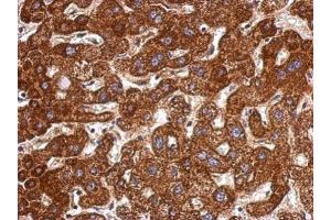 IHC-P Image Immunohistochemical analysis of paraffin-embedded human hepatoma, using LSS, antibody at 1:500 dilution. (LSS anticorps)