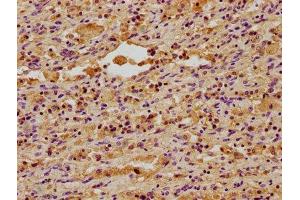 IHC image of ABIN7150498 diluted at 1:400 and staining in paraffin-embedded human lung cancer performed on a Leica BondTM system. (DNAJA3 anticorps  (AA 86-184))