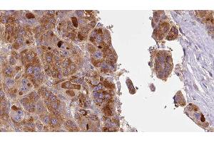 ABIN6277401 at 1/100 staining Human liver cancer tissue by IHC-P.