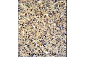 TPRGL Antibody (N-term) (ABIN651274 and ABIN2840164) IHC analysis in formalin fixed and paraffin embedded human cervix carcinoma tissue followed by peroxidase conjugation of the secondary antibody and DAB staining.