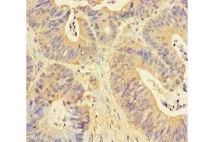 Immunohistochemistry of paraffin-embedded human colon cancer using ABIN7150594 at dilution of 1:100 (RPN1 anticorps  (AA 44-427))