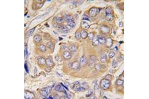 Formalin-fixed and paraffin-embedded human breast carcinoma tissue reacted with HSPB1 Antibody , which was peroxidase-conjugated to the secondary antibody, followed by DAB staining. (HSP27 anticorps  (Ser78))