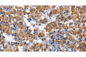Immunohistochemistry of paraffin-embedded Human thyroid cancer using HSF27 Polyclonal Antibody at dilution of 1:60 (CDK5RAP3 anticorps)