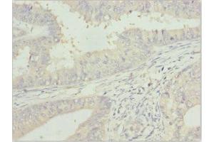 Immunohistochemistry of paraffin-embedded human endometrial cancer using ABIN7144060 at dilution of 1:100 (ZFAND3 anticorps  (AA 1-227))
