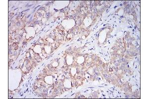 Immunohistochemical analysis of paraffin-embedded cervical cancer tissues using CD10 mouse mAb with DAB staining.