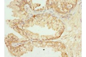 Immunohistochemistry of paraffin-embedded human prostate cancer using ABIN7162350 at dilution of 1:100 (GPR68 anticorps  (AA 276-365))