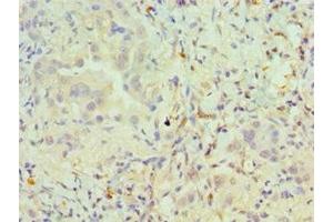 Immunohistochemistry of paraffin-embedded human lung cancer using ABIN7162504 at dilution of 1:100