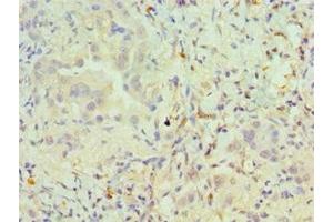 Immunohistochemistry of paraffin-embedded human lung cancer using ABIN7162504 at dilution of 1:100 (PAX6 anticorps  (AA 1-300))