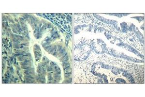 Immunohistochemical analysis of paraffin-embedded human colon carcinoma tissue using CDK6(Phospho-Tyr24) Antibody(left) or the same antibody preincubated with blocking peptide(right).