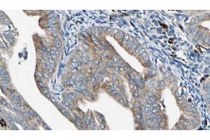 ABIN6272405 at 1/100 staining Human cervical cancer tissue by IHC-P. (RAB11B anticorps  (C-Term))