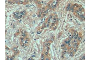 Detection of HSPA1A in Human Liver cancer Tissue using Anti-Heat Shock 70 kDa Protein 1A (HSPA1A) Monoclonal Antibody (HSP70 1A anticorps  (AA 285-641))