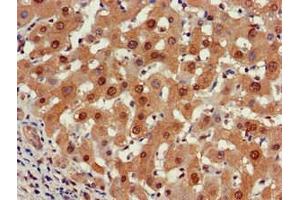 Immunohistochemistry of paraffin-embedded human liver cancer using ABIN7164960 at dilution of 1:100 (PSMA5 anticorps  (AA 124-180))