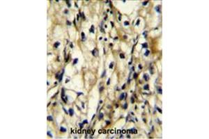 BCAT1 Antibody (Center) immunohistochemistry analysis in formalin fixed and paraffin embedded human kidney carcinoma followed by peroxidase conjugation of the secondary antibody and DAB staining.