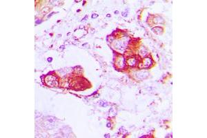 Immunohistochemical analysis of CNT2 staining in human lung cancer formalin fixed paraffin embedded tissue section.