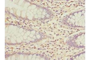 Immunohistochemistry of paraffin-embedded human colon cancer using ABIN7163881 at dilution of 1:100 (GALNT2 anticorps  (AA 442-571))