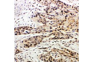 Anti-Caspase-14 antibody, IHC(P) IHC(P): Human Oesophagus Squama Cancer Tissue (CASP14 anticorps  (C-Term))