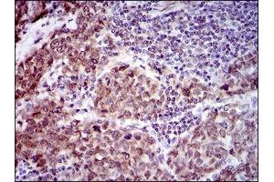 Immunohistochemical analysis of paraffin-embedded breast cancer tissues using CLGN mouse mAb with DAB staining. (Calmegin anticorps  (AA 249-405))