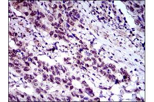 Immunohistochemical analysis of paraffin-embedded esophagus cancer tissues using CFLAR mouse mAb with DAB staining.