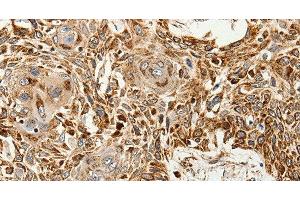 Immunohistochemistry of paraffin-embedded Human esophagus cancer tissue using SLC9A7 Polyclonal Antibody at dilution 1:60 (NHE7 anticorps)